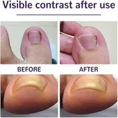 Ayak Tırnağı Düzeltme Bandı 50 Adet - 1