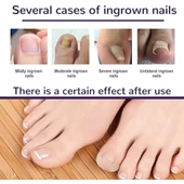 Ayak Tırnağı Düzeltme Bandı 50 Adet - 4