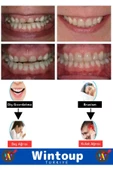 Premium Seri Bruxism Çene Sıkma Diş Gıcırdatma Koruyucu Aparatı Dişlik Gece Plağı Dişlik - 2