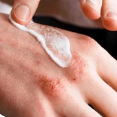 Ducray Dexyane Baume Anti Grattage Emollient Balm 400 ml thumbnail 2