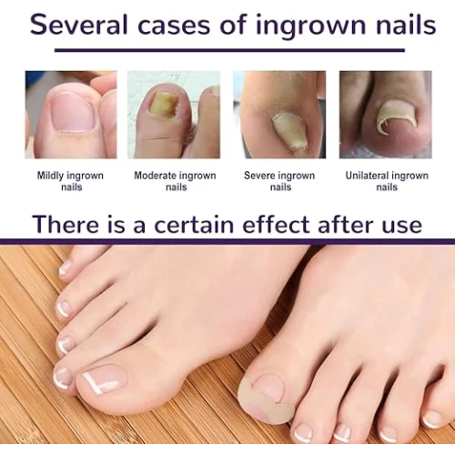 Ayak Tırnağı Düzeltme Bandı 50 Adet - 4