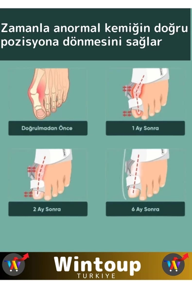 Premium Seri Yıkanabilir Standart Size Sağ Sol Ayak Uyumlu Baş Parmak Kemik Düzeltici 2 Adet - 4