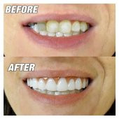 Perfect Smile Tak Kullan Takma Beyaz Diş - 4