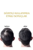 FORX5 Sarı Serum& Dermaroller Set - 3