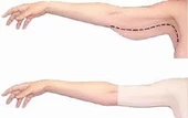 YENİ İNCİ LAZER KESİM KOL VE SIRT TOPARLAYICI KORSE 0055 - 10