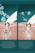 NEUTRON Vakumlu Ultrasonik Siyah Nokta Temizleyici - 6