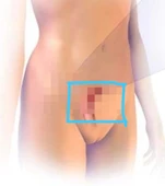 PELVİK Hint Yağı Sargı Bezi - 2