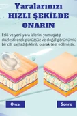 Silikon Yara Jeli  Keloid, Ameliyat, Yanık Ve Yaralanma Izleri Için Tıbbi Kalitede Jel - 6