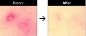 Anua - Heartleaf Centella Red Spot Cream(leke kremi)(GLOBALCARE) - 4