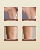 Mieco Sapphire Soğutma Özellikli IPL Lazer Epilasyon Aleti (Safir Cam) - MOR + Gözlük ve Çanta Hediyeli - 6