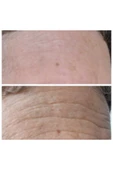xaura 8 Milyon Mikro Iğne Içeren Kalıcı Botoks Etkili Anti-aging Kremi, 24k 1000 Ppm Altın Içerir, - 2