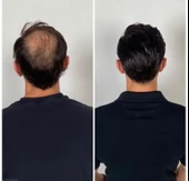 RollerOn Hair-Derma Roller Saç için Titanyum Mikro İğneli 2.00mm Saç Roller - 4