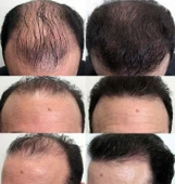 RollerOn Hair-Derma Roller Saç için Titanyum Mikro İğneli 2.00mm Saç Roller - 5