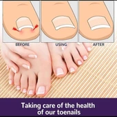 Ayak Tırnağı Düzeltme Bandı 50 Adet - 2