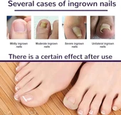 Ayak Tırnağı Düzeltme Bandı 50 Adet - 5