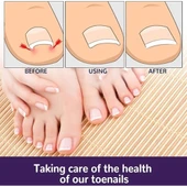 Ayak Tırnağı Düzeltme Bandı 50 Adet - 3