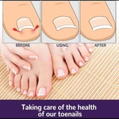 Litae Trend Ayak Tırnağı Düzeltme Bandı 50 Adet thumbnail 3