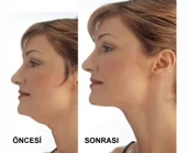 Gıdı Toparlama Boyun Gıdı Masaj Aleti thumbnail 2