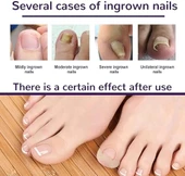 Ayak Tırnağı Düzeltme Bandı 50 Adet thumbnail 5
