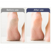 Xiaomi Enchen Şarjlı Ayak Bakım Masajı Nasır Sökücü - 7