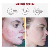 NEDOX Cilt Yenileyici Cilt Tonu Eşitleyici Kırmızı Peeling Serum Aha %30 Bha %2 Ph % 3.5 Serum 30 ml - 5