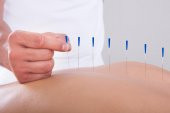 Akupunktur iğnesi
kuru iğne,
Acupuncture needle 0.25*40mm - 2
