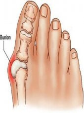 Supportline 2 Adet Halluks Valgus Gece Ateli HALLUKS - 1