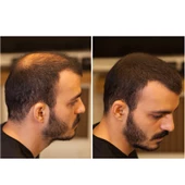 Fixdeep Yeni Nesil Saç Dolgunlaştırıcı Pudra 14 Gr. - Seyrek Saçlar için Saç Fiberi - Fixdeep Suda Çıkmaz - 2