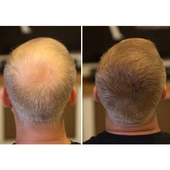 Saç Dolgunlaştırıcı Set Topik 28 Gr. + Sprey - Seyrek Saçlar için Saç Tozu - Fixplant Saç Fiberi - 4