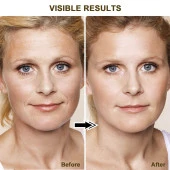 LEFAY Radyo Frekansı Cilt Sıkılaştırma Yüz Makinesi - Yaşlanma Karşıtı Sihirli Değnek - 5