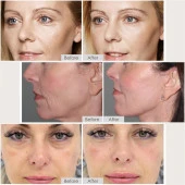 LEFAY Radyo Frekansı Cilt Sıkılaştırma Yüz Makinesi - Mikro Akım Yaşlanma Karşıtı - 3