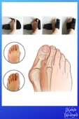 Halluks Valgus Gece Ateli Ayak Baş Parmak Kemik Çıkıntısı Düzeltici Bunyon Tedavisi - 3