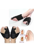 Halluks Valgus Gece Ateli Ayak Baş Parmak Kemik Çıkıntısı Düzeltici Bunyon Tedavisi - 4