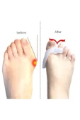 Orta Parmağa Geçen Metatarsal Pad thumbnail 6