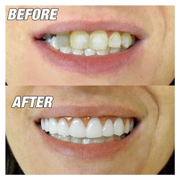 Perfect Smile Tak Kullan Takma Beyaz Diş - 4