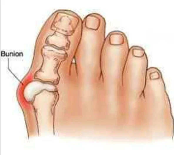 Silikon Makara Ayak Başparmak Ayırıcı Kemik Bunyon Nasır Koruyucu - 3