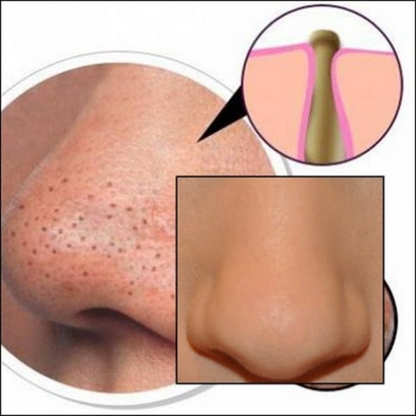 Siyah Nokta Giderici Burun Bandı 6lı