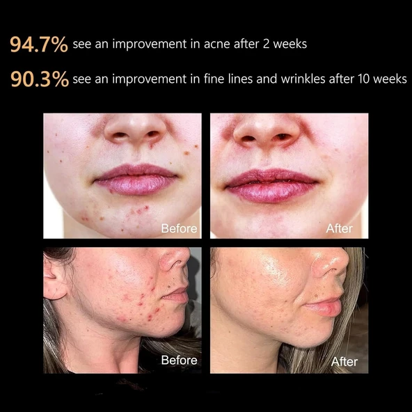 Aphrona Moonlight 3 Renkli LED Yüz ve Cilt Bakım Maskesi - Işık Terapisi - 3