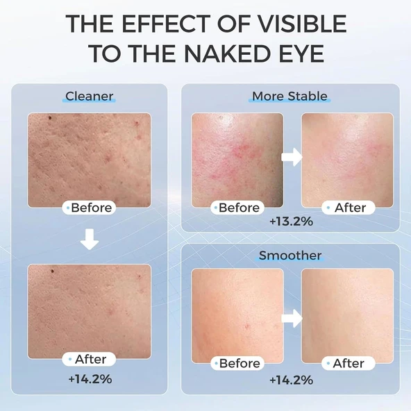 EVFOFO Yüz için Kırmızı ve Mavi Kırmızı Işık Terapi Maskesi - 4