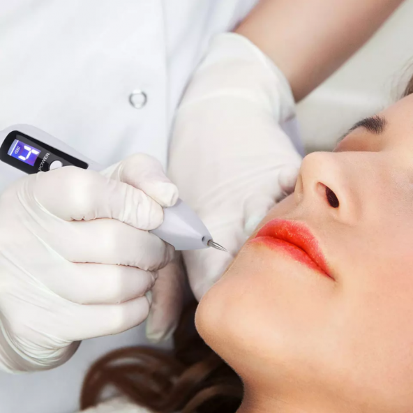 PLASMA PEN - AKNE, YARA İZİ, BEN, DÖVME TEMİZLEME KALEMİ - 2