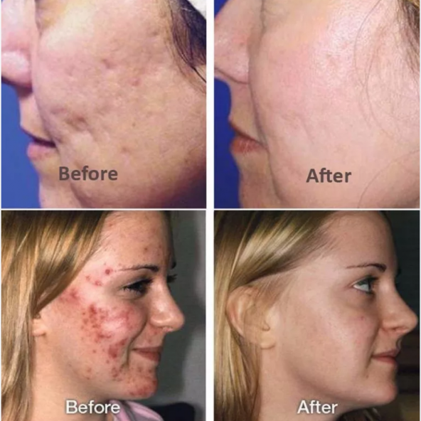 BioAqua Pure Skin Akne Sivilce Ve İz Kremi - 3