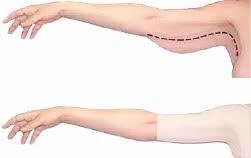 YENİ İNCİ LAZER KESİM KOL VE SIRT TOPARLAYICI KORSE 0055 - 12