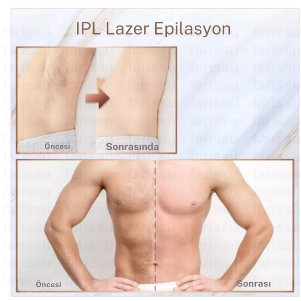 Trend Farma Soğuk Buz İpl Lazer Epilasyon Cihazı - 999.999 Atım,  Ağrısız buz lazer - 4