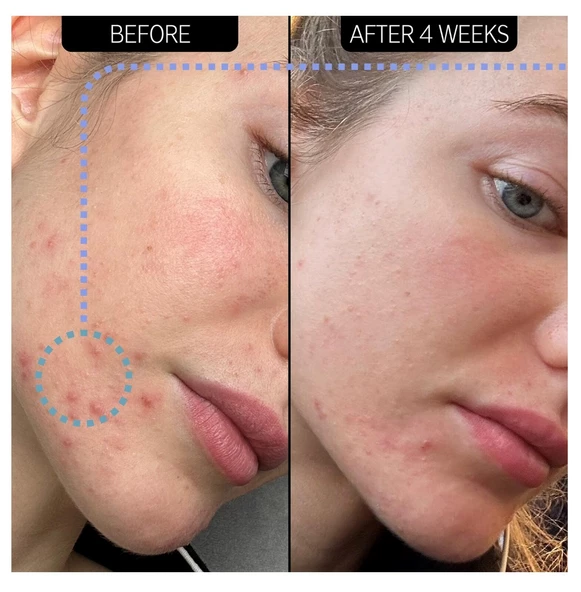 THE INKEY LIST Blemish Clearing Moisturizer 2% NovoRetin - Nemlendirici Gece Kremi 50 ml - 2