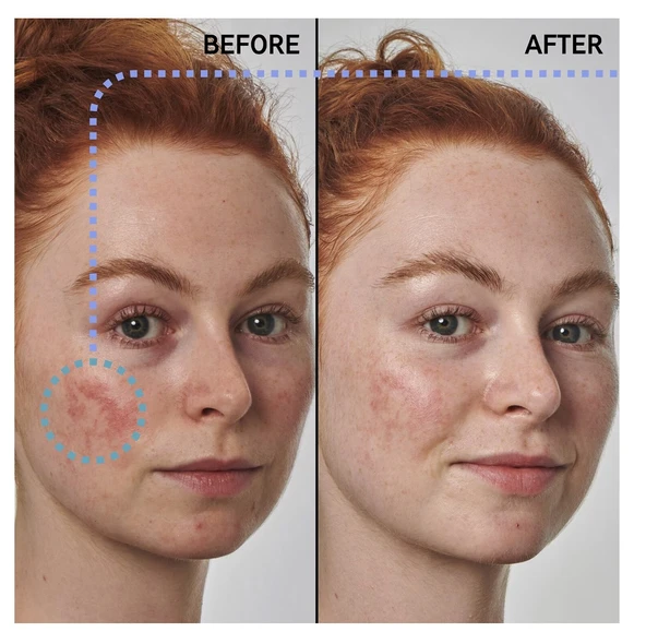 THE INKEY LIST Redness Solution with 10% Azelaic - Yüz Serumu 30 ml - 2