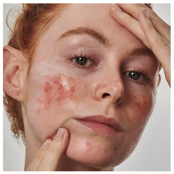 THE INKEY LIST Redness Solution with 10% Azelaic - Yüz Serumu 30 ml - 4