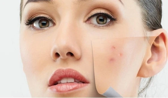 ORGANICYOU SEBIUM AKNE KARŞITI DOĞAL CİLT BAKIM KREMİ 100 ML - 5