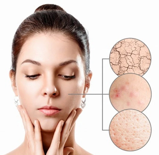 ORGANICYOU SEBIUM AKNE KARŞITI DOĞAL CİLT BAKIM KREMİ 100 ML - 3