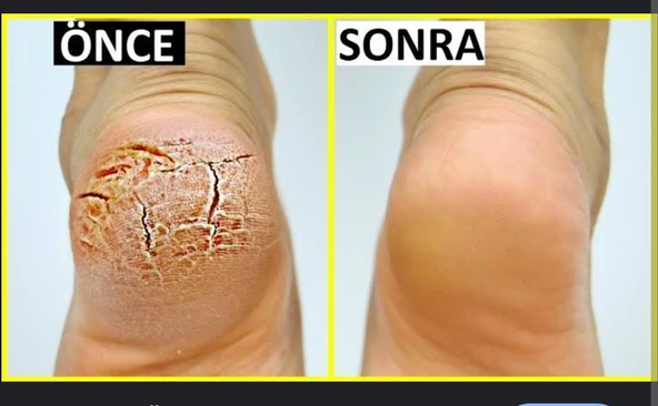 ORGANICYOU AYAK BAKIM ve ÇATLAK & KOKU BIOTERAPİ KREMİ 100 ML - 5