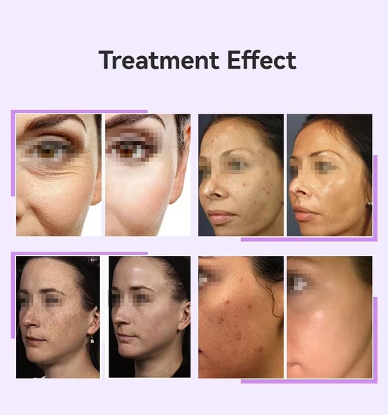 Dijital Yüksek Frekans Cihazı 6 Problu Yüz Cilt Bakım Gençleştirme Anti-Aging - 7